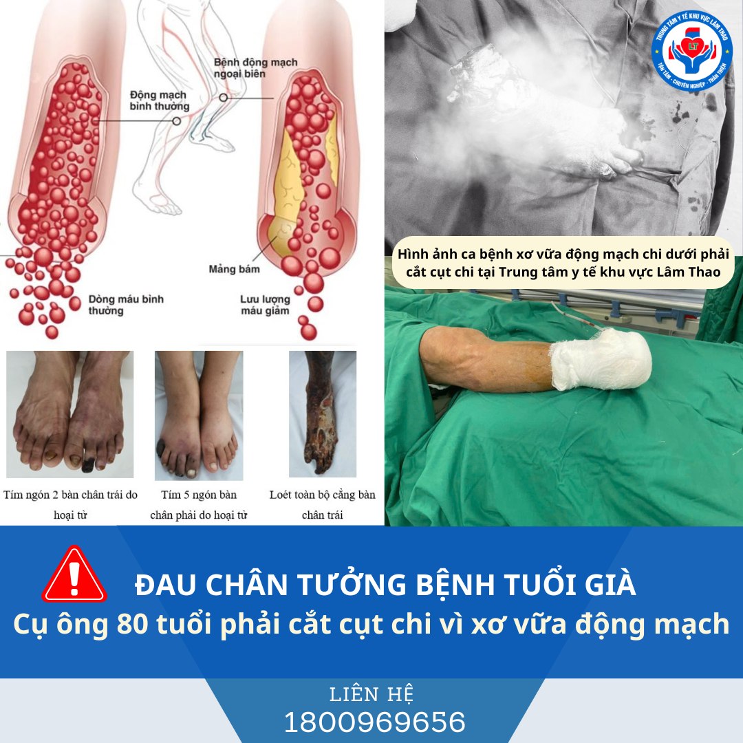Đau chân tưởng bệnh tuổi già, cụ ông 80 tuổi phải cắt cụt chi do xơ vữa động mạch chi dưới